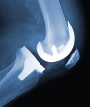Knee Implant