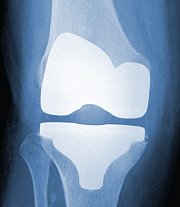 Knee Replacement