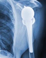 Shoulder Replacement