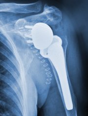 Shoulder Replacement X-ray